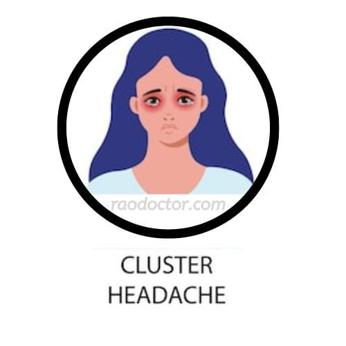 Picture depicting cluster headache