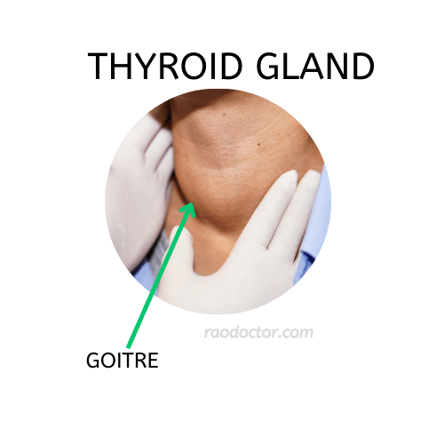 Picture showing goitre of thyroid