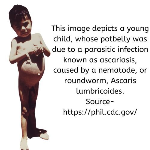 Picture of a potbellied child due to worm infestation