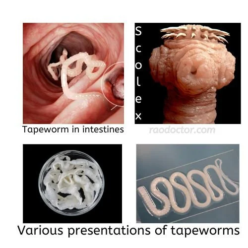 How To Know Which Type of Worms Inhabit Your Bowels- 5 Ways to Treat Them 7 Different presentation of tape worms infestation