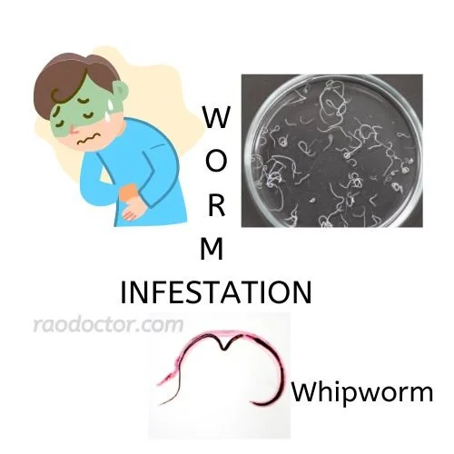Worms in intestine Title picture showing infestation by multiple worms