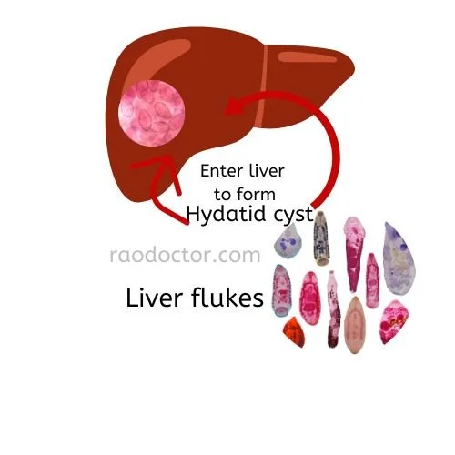 How To Know Which Type of Worms Inhabit Your Bowels- 5 Ways to Treat Them 9 Formation of hydatid cyst from liver flukes