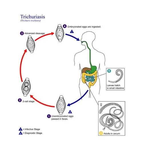 How To Know Which Type of Worms Inhabit Your Bowels- 5 Ways to Treat Them 5 Worm infestation