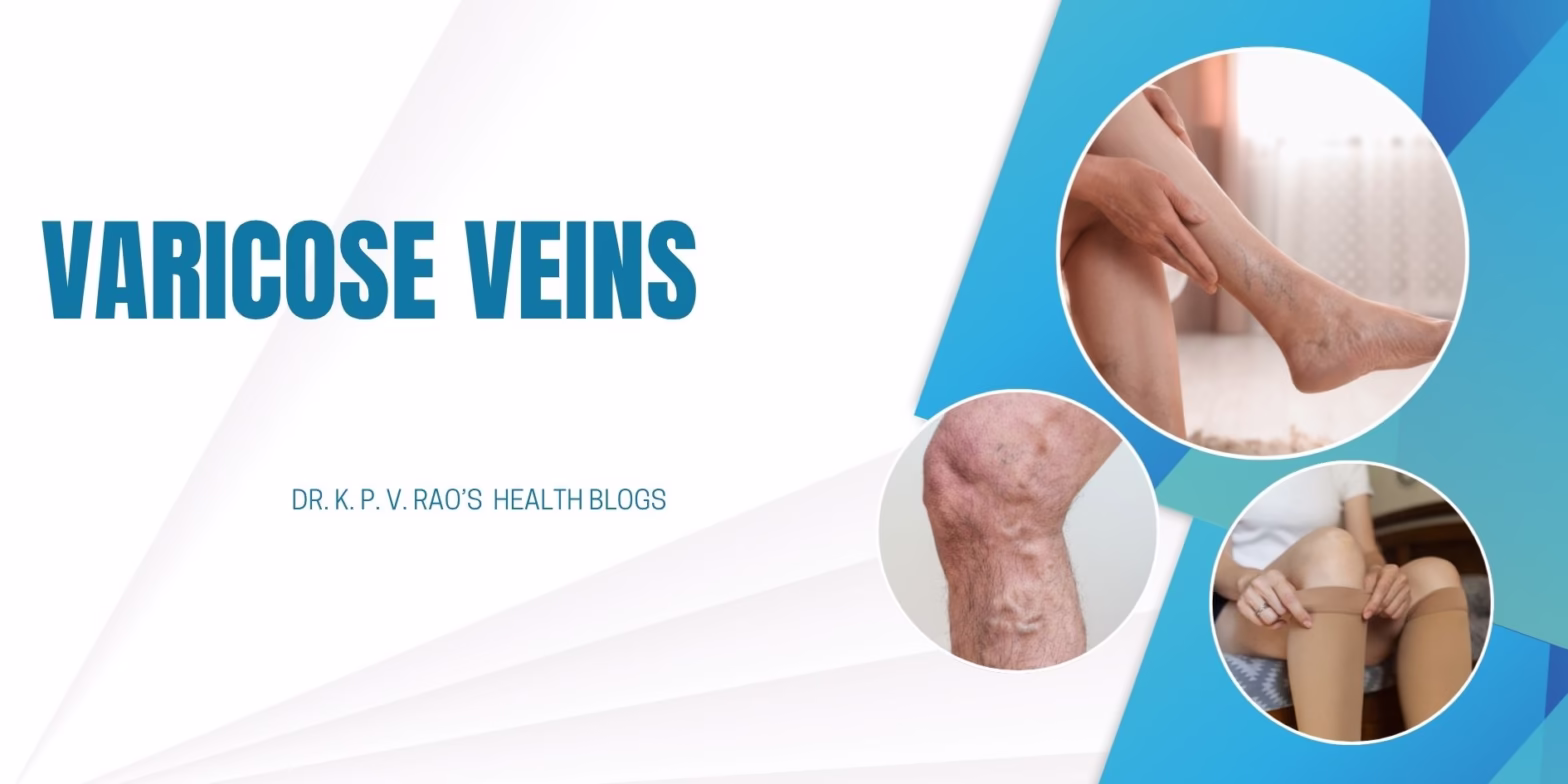 Varicose veins- Are they Good or Bad for you? 1 Blog post image showing varicose veins