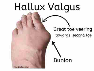 Hallux Valgus in left foot