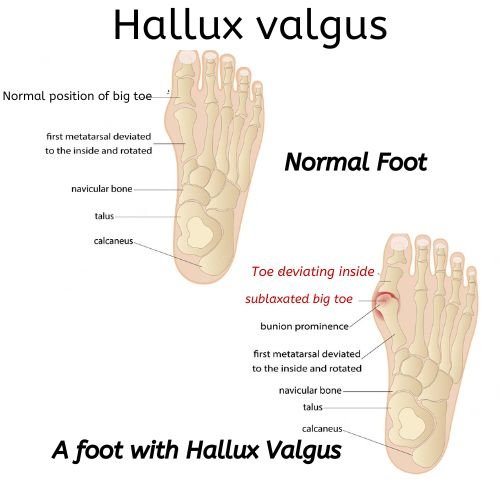 Picture showing difference between normal foot and a foot with hallux valgus