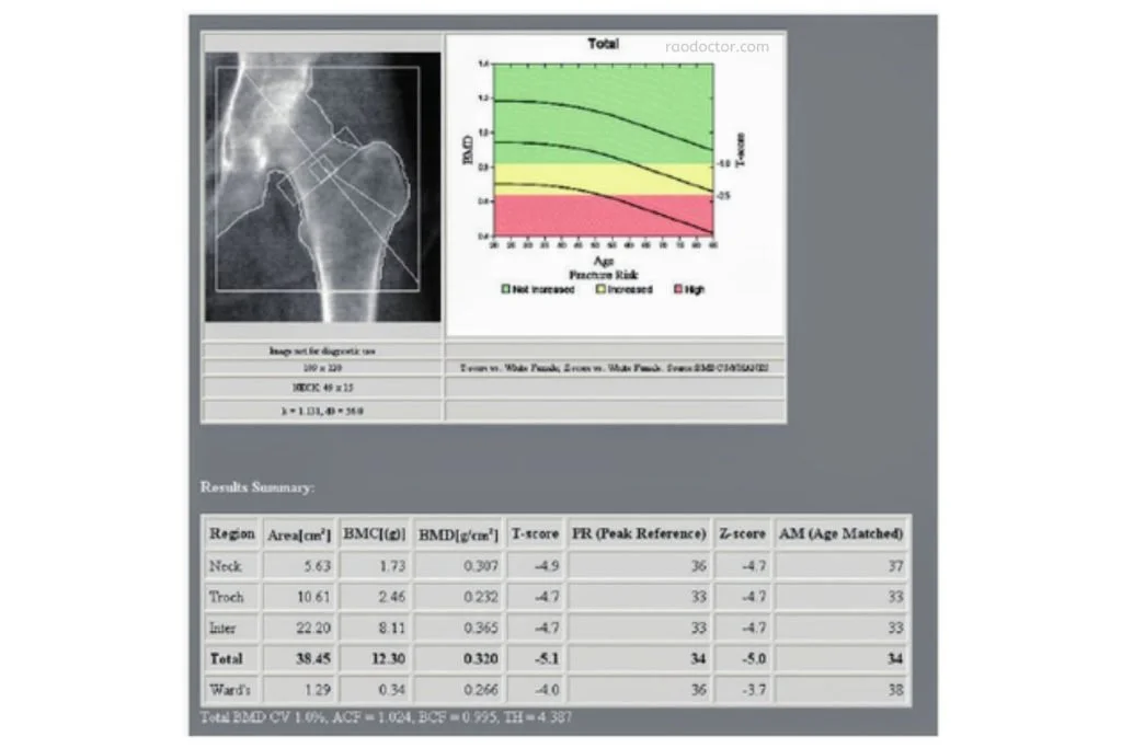 A dexa scan showing bmd of thigh bone femur showing osteoporosis