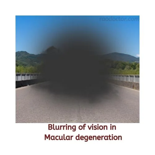 Blurring of vision in macular degeneration of eyes