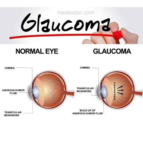 Picture showing how glaucoma of eyes happens
