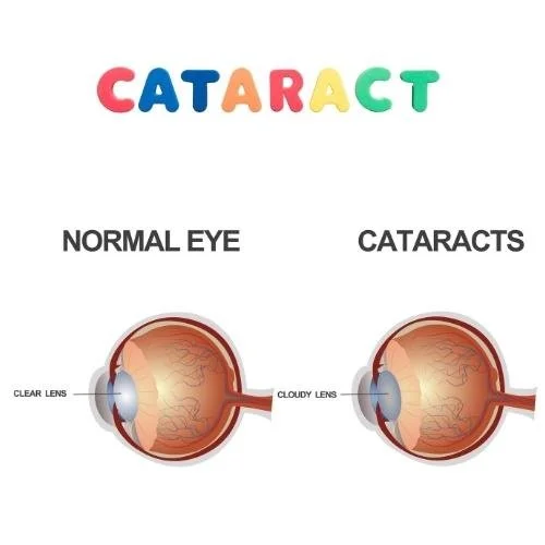 Picture showing cataract  of eyes