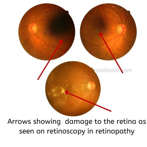 Picture showing damage to retina in retinopathy of eyes