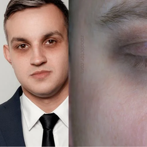 Dark circles below the eyes