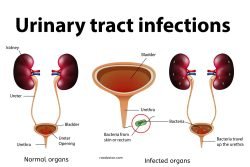 Featured image showing urinary tract infections