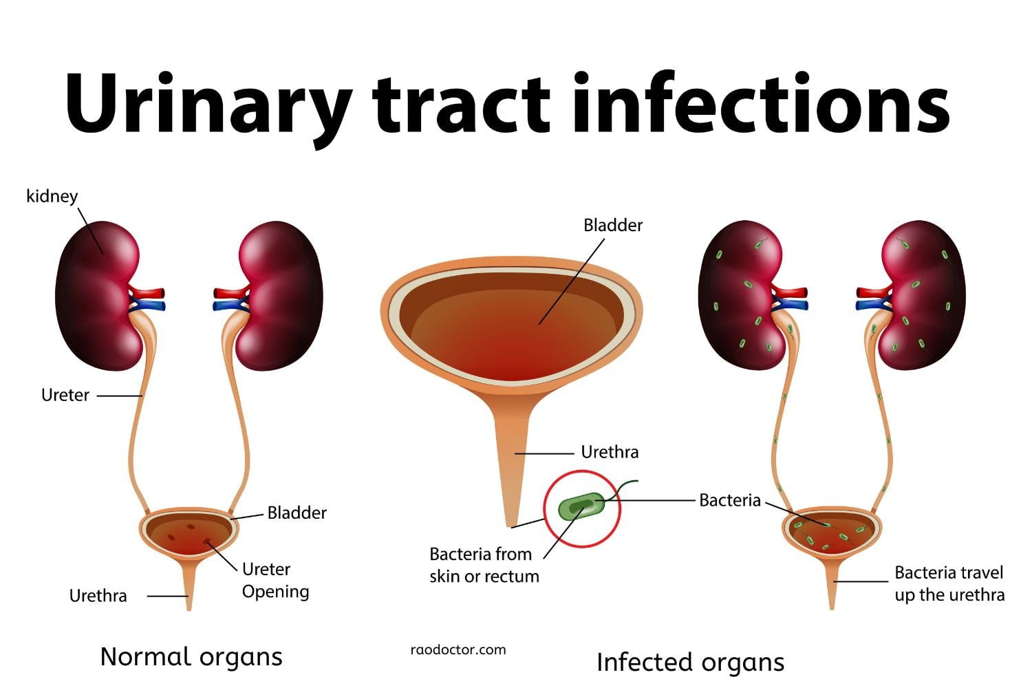 Urinary Tract Infections How To Diagnose And Treat Them 8957