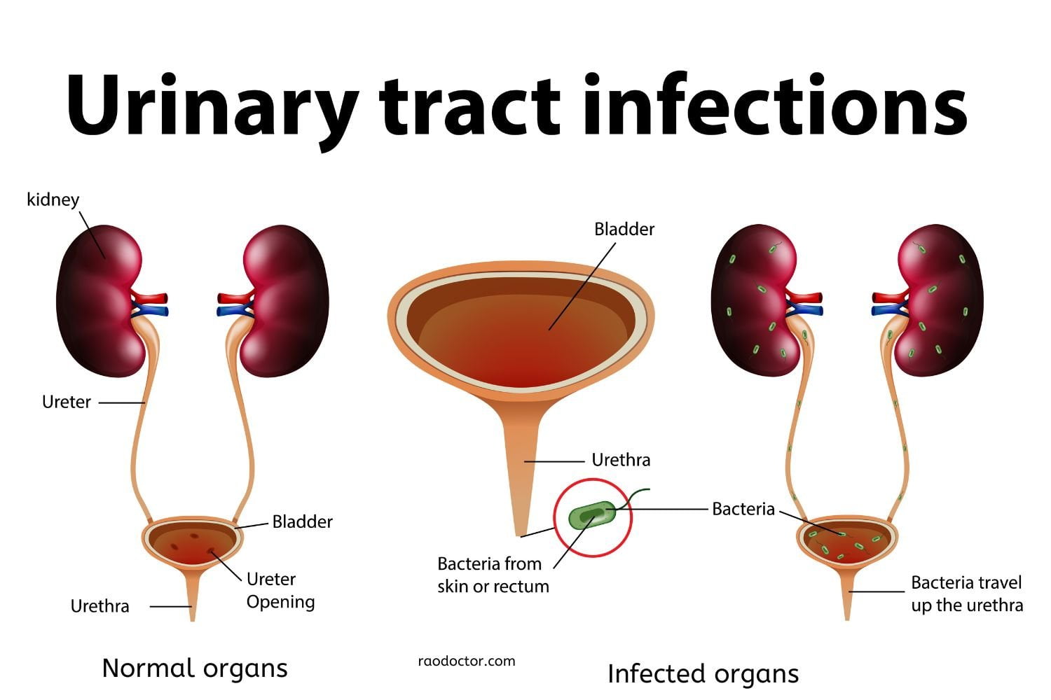 urinary-tract-infections-active-learning-templates-therapeutic