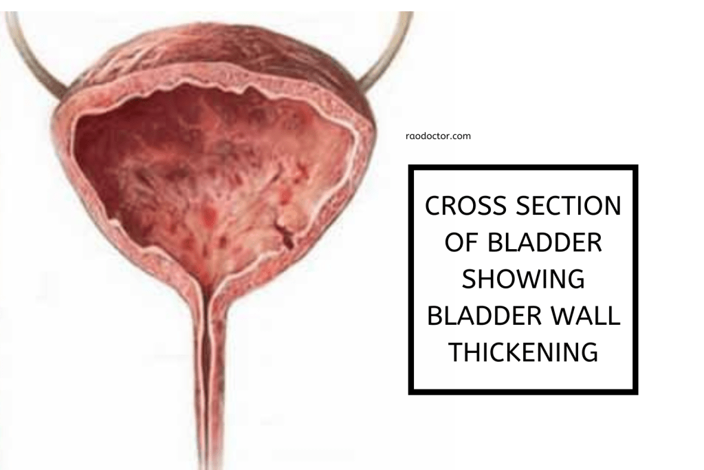 Cross section of bladder with chronic Cystitis