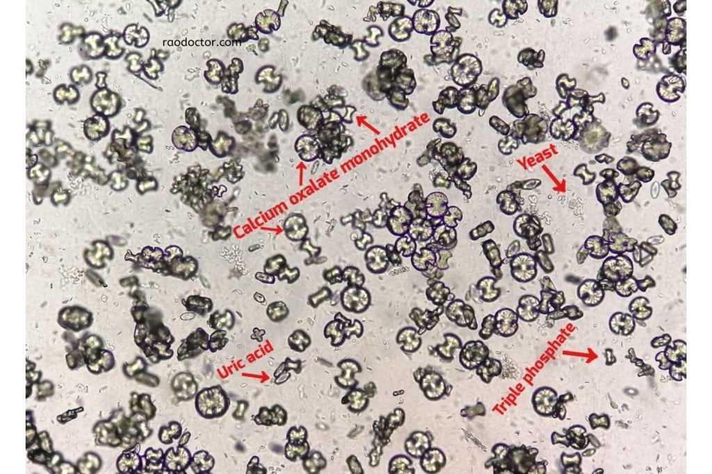 Urine microscopy test revealing crystals and yeast cells