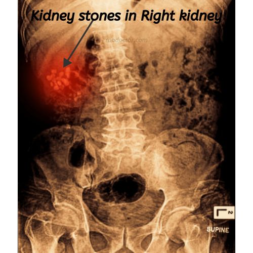 Image showing kidney stones in the right kidney