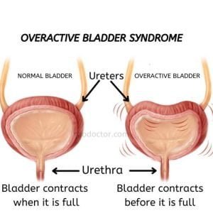How To Manage Overactive Bladder Syndrome
