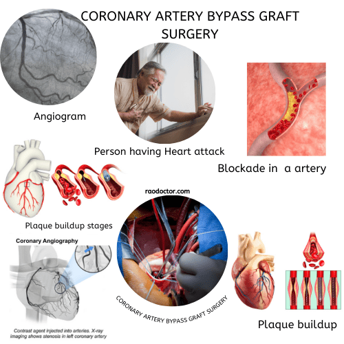 Coronary artery bypass graft surgery feature image