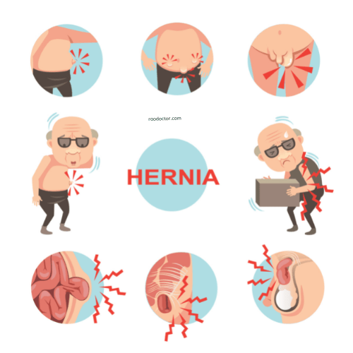 Vector showing Hernia- different types