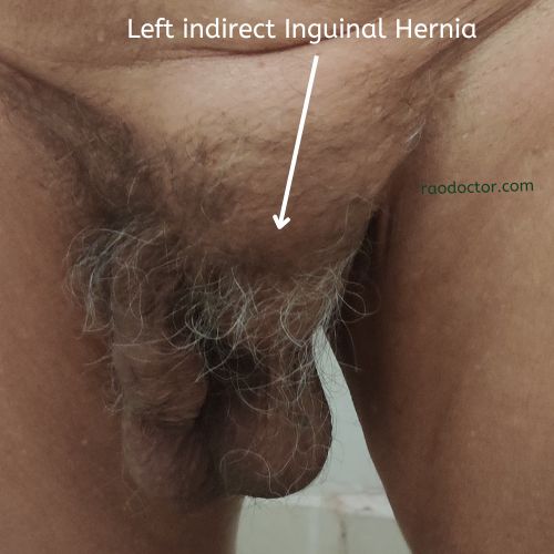 Left indirect Inguinal Hernia