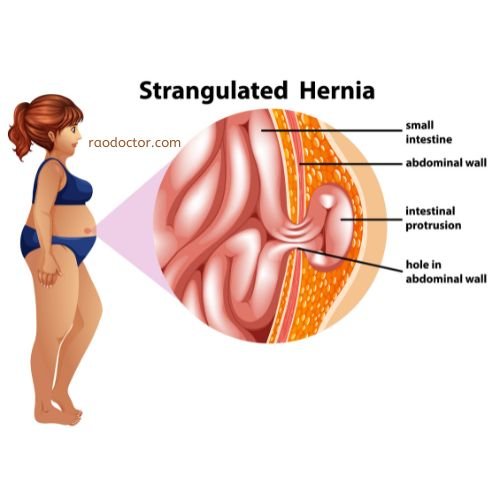 Stangulated hernia
