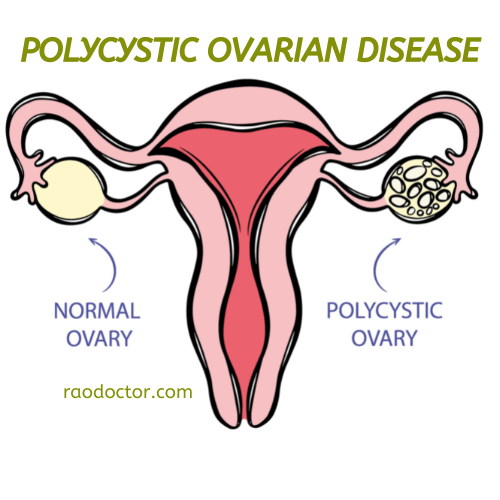 Picture showing Polycystic Ovarian Disease