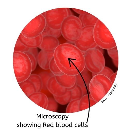 Red blood cells in anemia due to Vitamin B12 deficiency