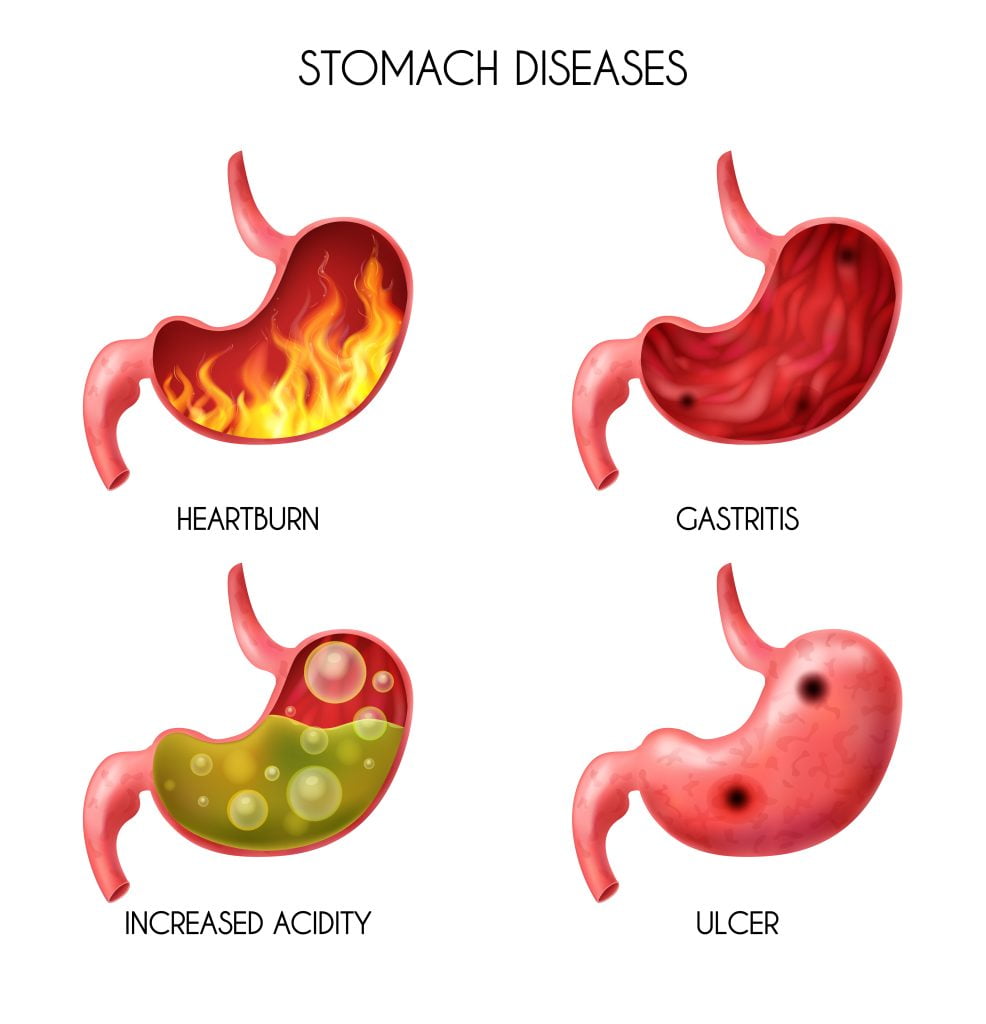 15331878 1906. I305. 004 realistic human internal organ stomach pyrosis fire disorder gastric acid reflux abdominal bloated ball nausea