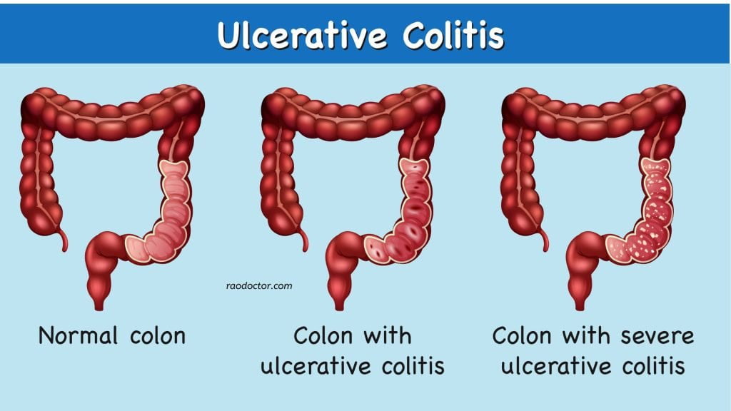 Ulcerative colitis in GI diseases