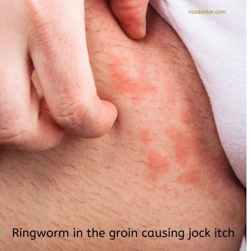 Groin ringworm in skin disease