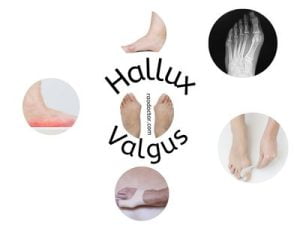 Picture showing Hallux Valgus and its management