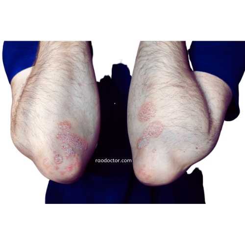 Psoriasis appears symmetrically on parts of the body