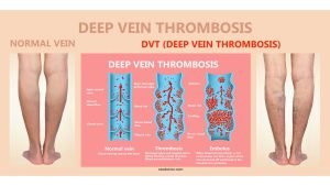 Featured image showing Deep Vein Thrombosis and Normal leg veins