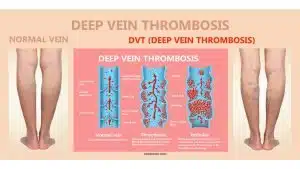 Featured image showing deep vein thrombosis and normal leg veins