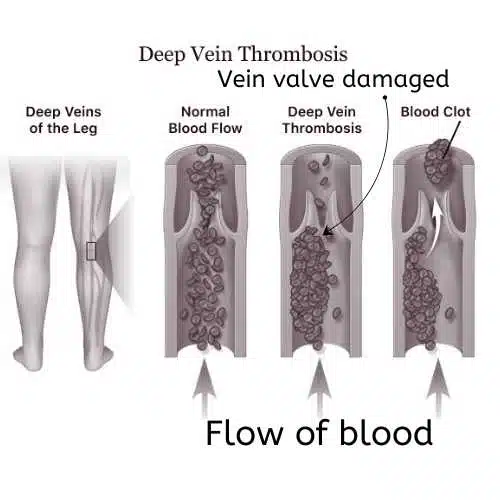 Stages of formation of clot in deep vein thrombosis