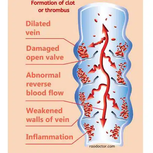 Formation of thrombus in deep vein thrombosis