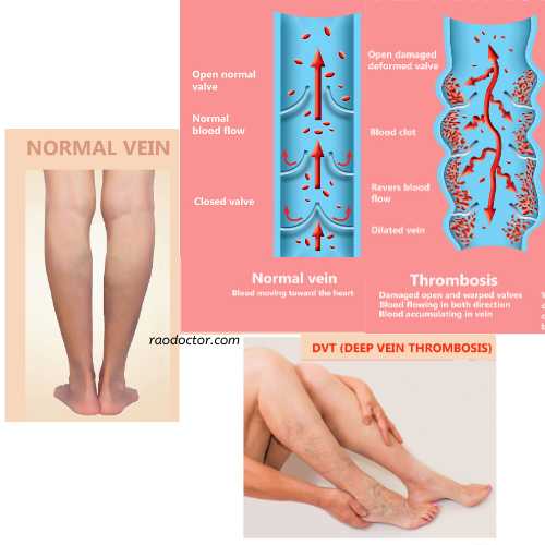 Image showing normal vein and deep vein thrombosis