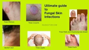 Ultimate Guide To Fungal Skin Infections-Learn How to Tackle Them 1 Image showing fungal skin infections