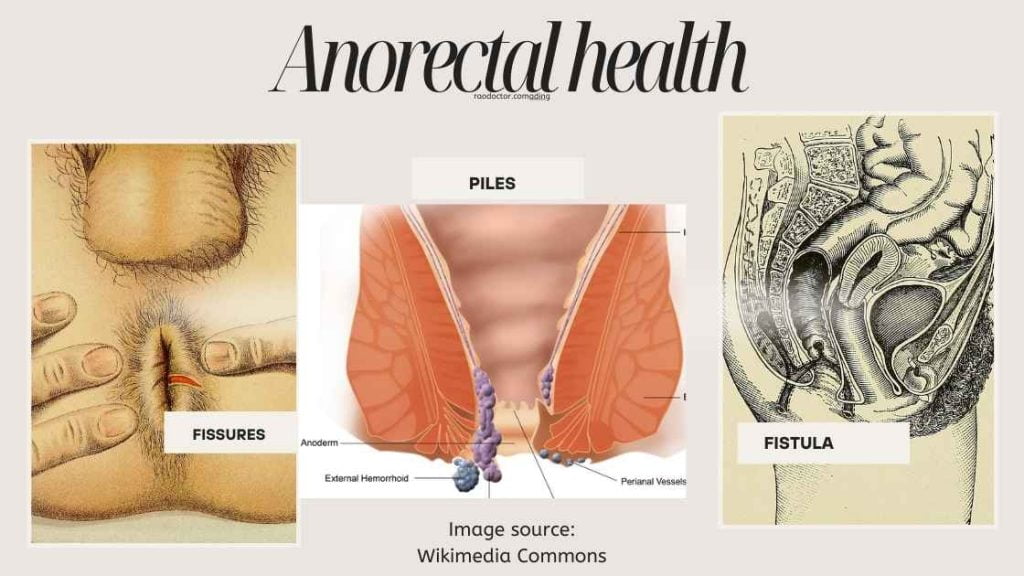 Image showing Fissures, piles and fistula in Anorectal Health