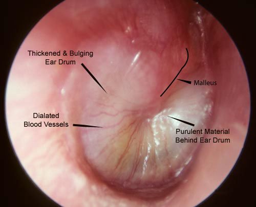 Middle ear infection-otitis media