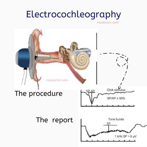 Electrococleography test in Tinnitus