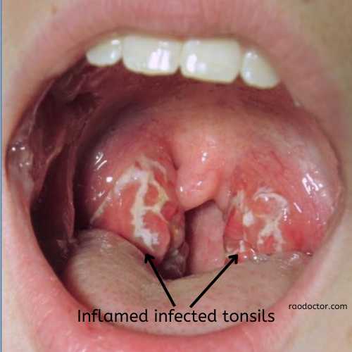 Tonsillitis with infective patches