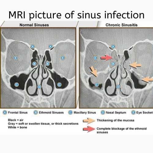 MRI PICTURE OF NORMAL AND INFECTED SINUSES
