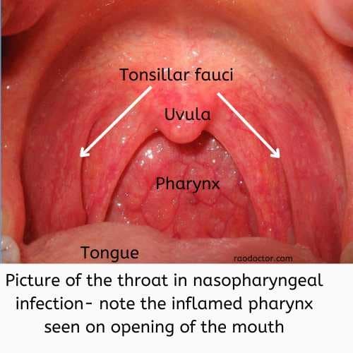 Pharyngitis in nasopharyngeal infections