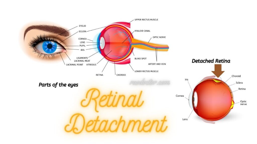 Featured image for Retinal Detachment Article