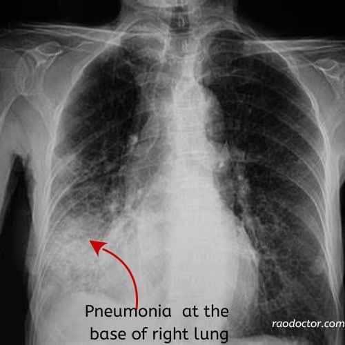 X-ray showing pneumonia