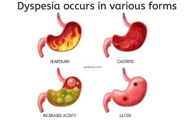 What is Dyspepsia or Acid Peptic Disease - Symptoms, Diagnosis and Treatment 2 Different forms of dyspepsia
