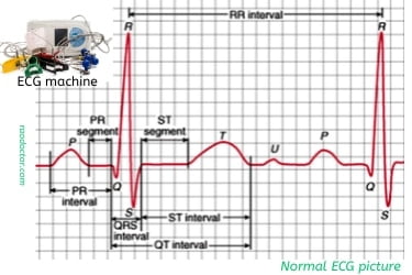Picture showing a normal electrocardiogram with picture of ECG machine in the inset.